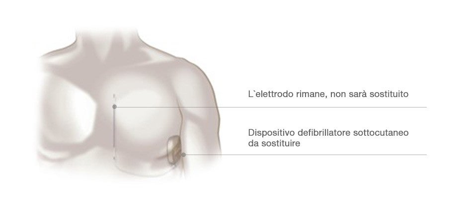 sostituzione del dispositivo s-icd necessaria