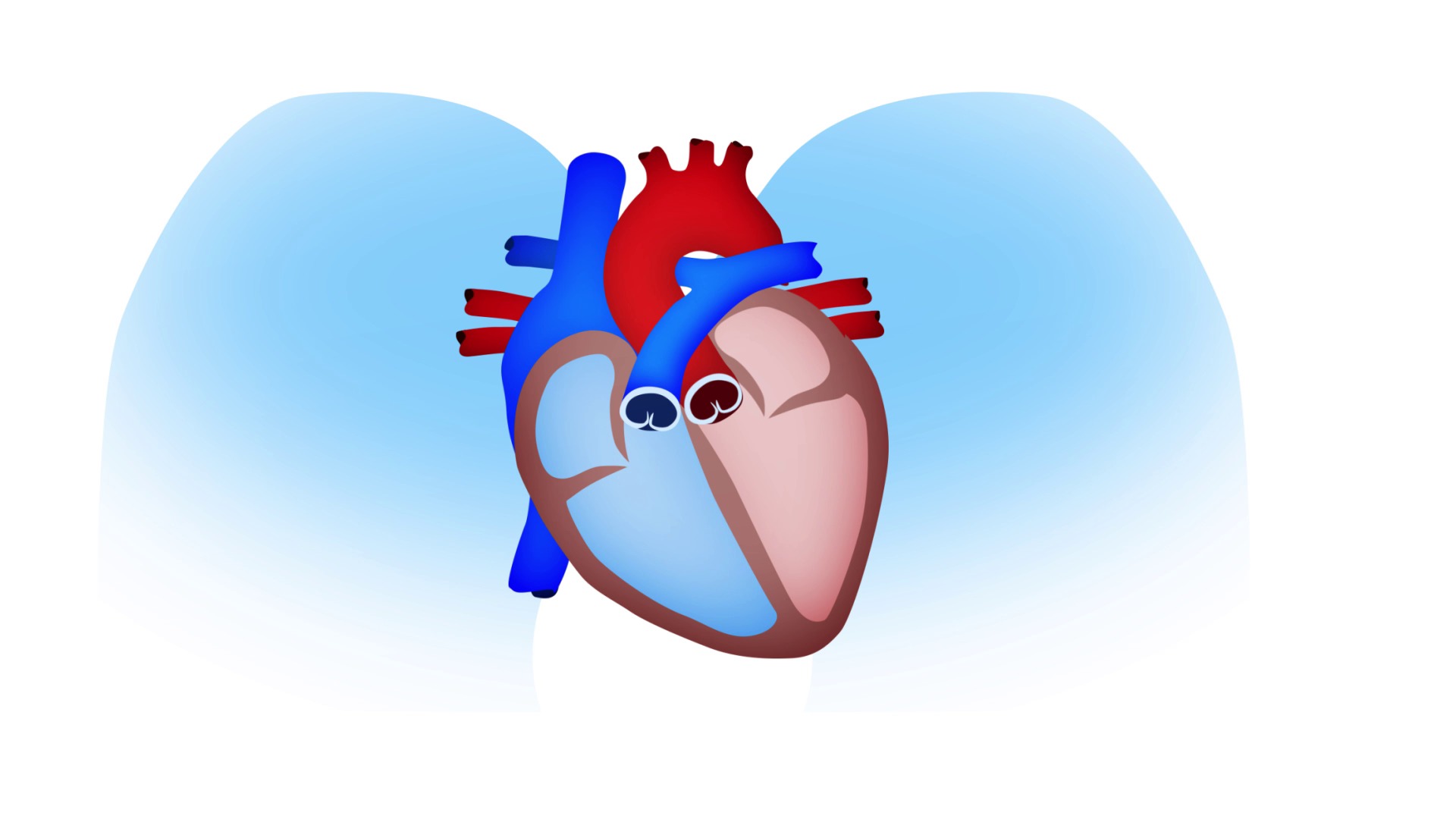 Sudden Cardiac Arrest (SCA) explained Sudden Cardiac Arrest (SCA) explained