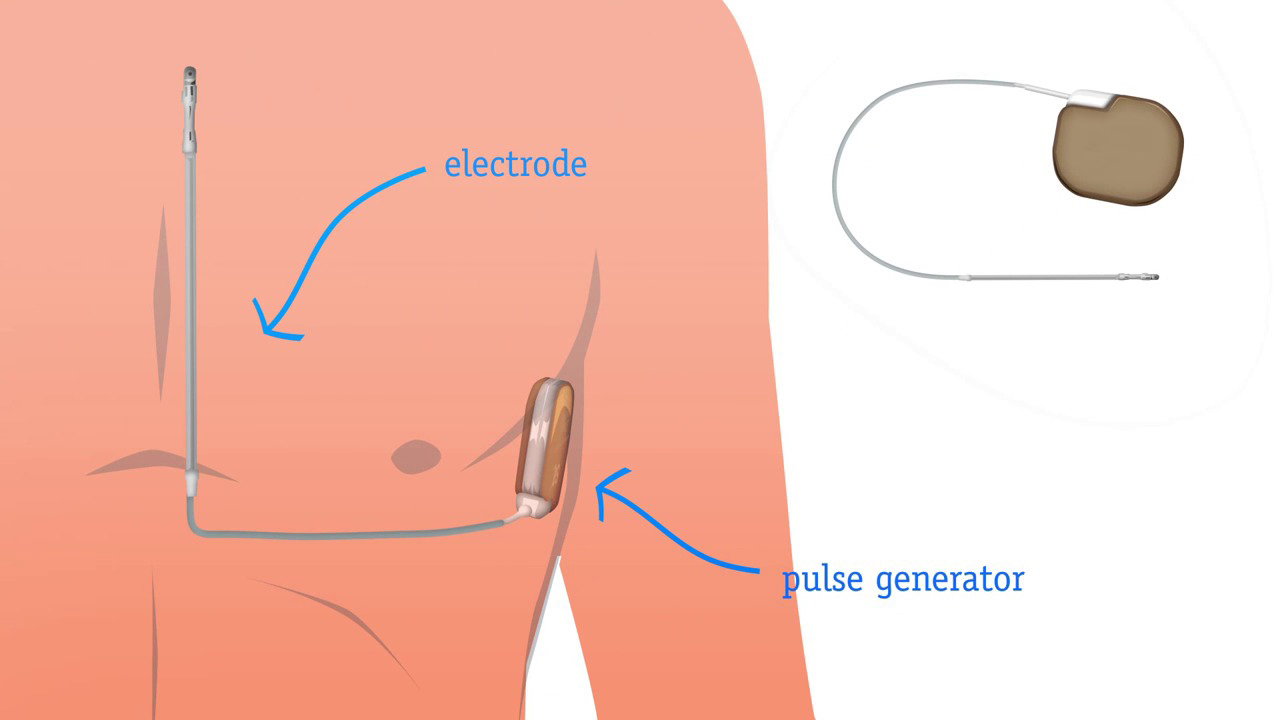 Watch video on a transveneous ICD implant procedure