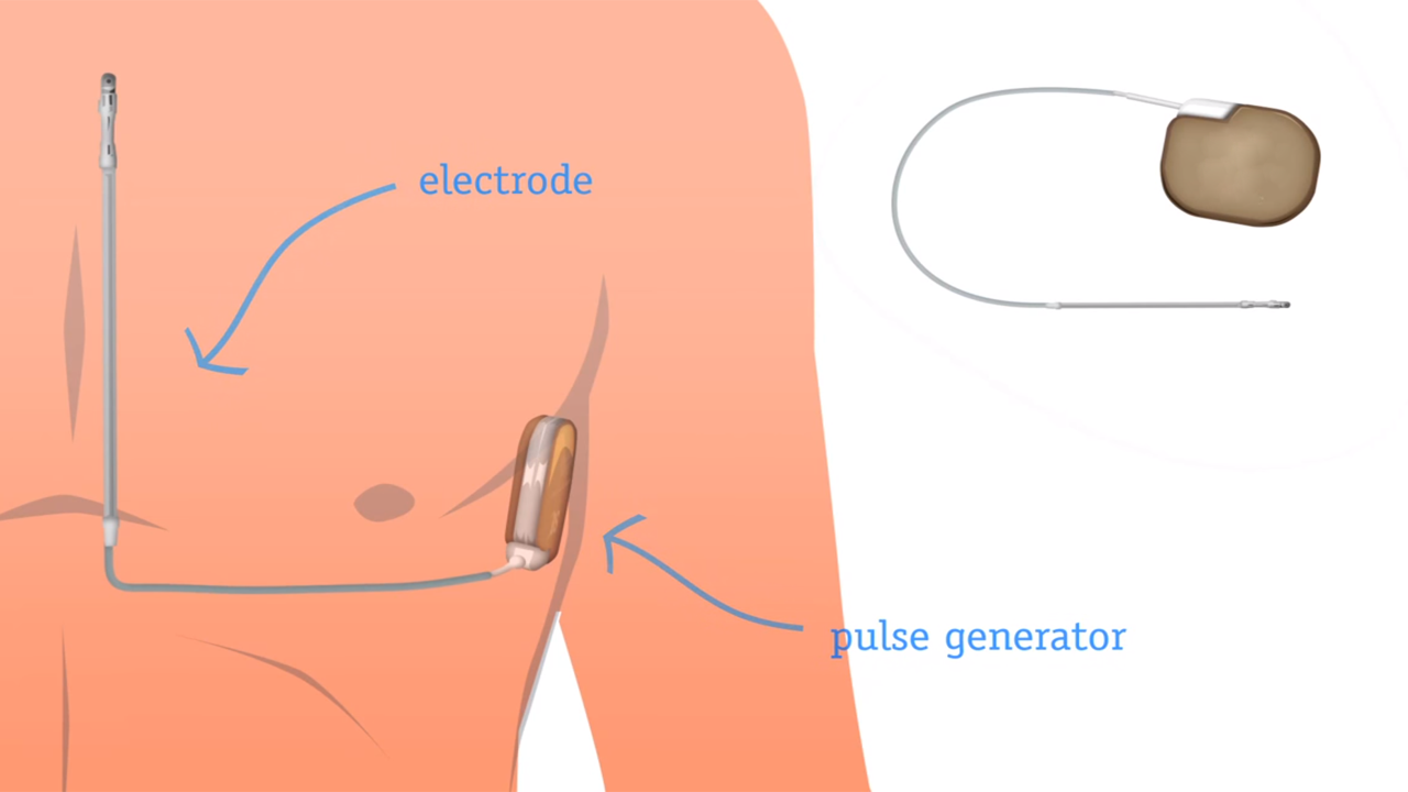 How the S-ICD Works How the S-ICD Works