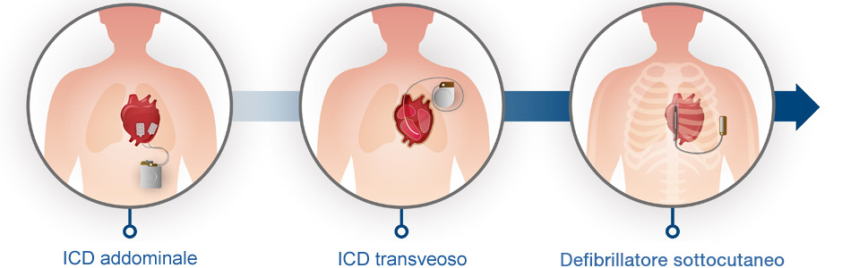 Evoluzione del dispositivo ICD all'S-ICD